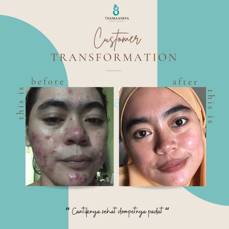 SKINCARE TSAMAANIYA PAKET ACNE SOLUTION ASLI BPOM