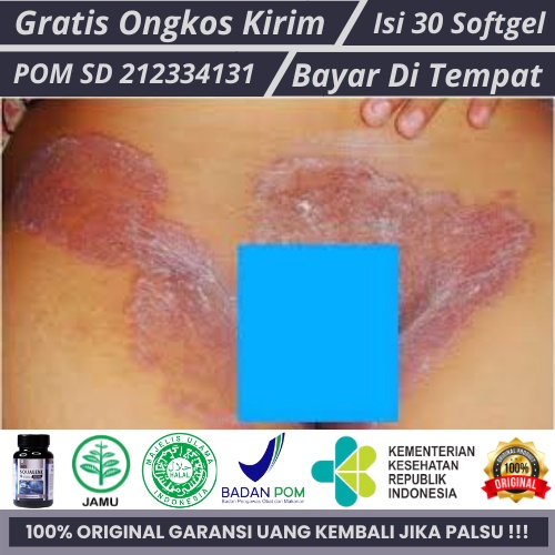 Jual Obat Gatal Selangkangan Obat Selangkangan Gatal Dan Hitam Obat