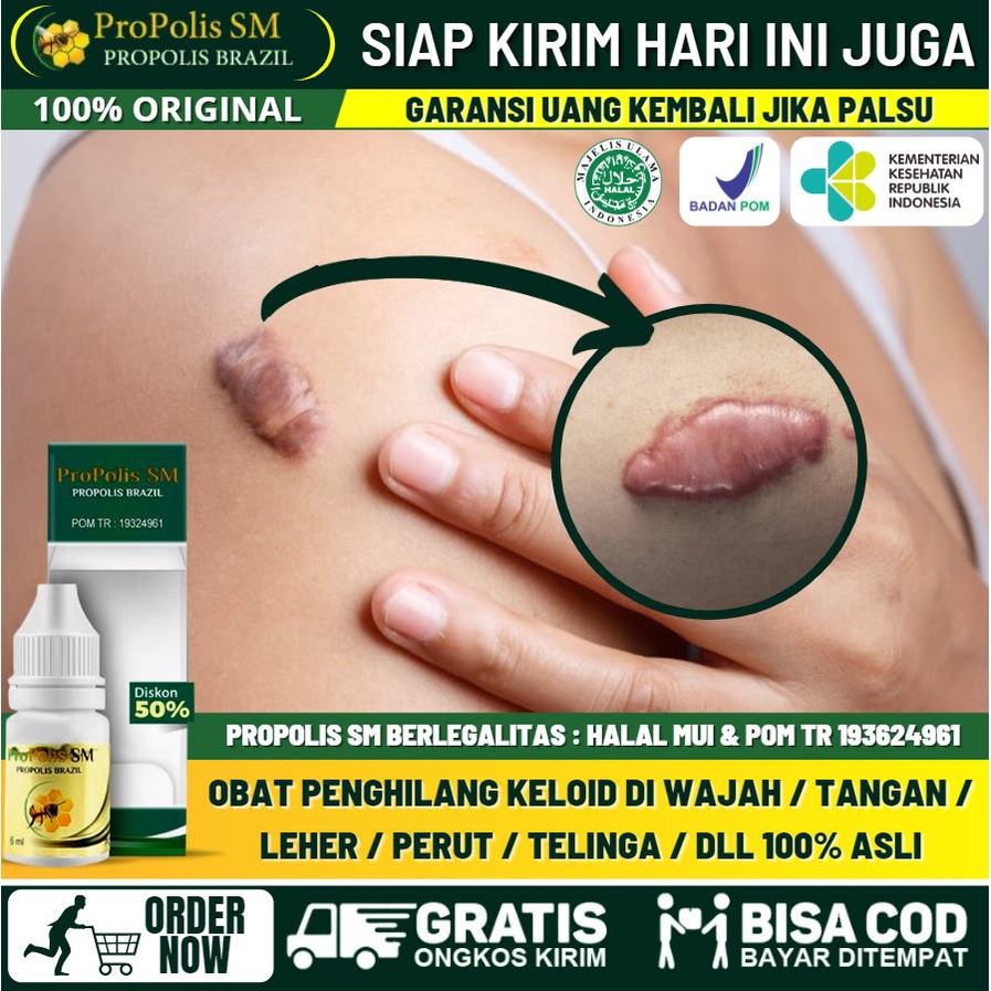 Salep Keloid 100% ASLI, Menghilangkan Keloid Berwarna Merah / Hitam / Ungu / Coklat, Obat Keloid di 
