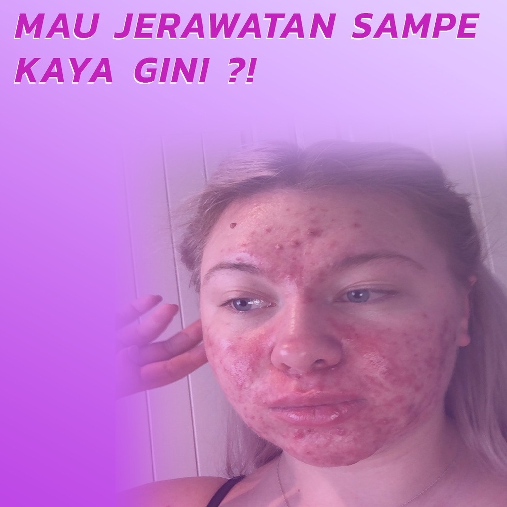 Scarlett Whitening Acne Cream Night / Acne cream malam