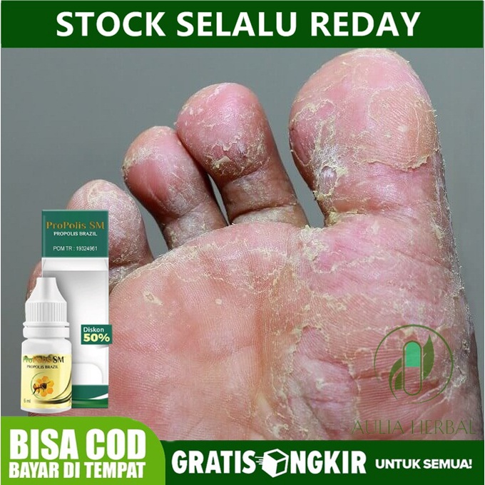 Obat Kutu Air, Penghilang Kutu Air, Obat Kutu Air di Telapak Kaki, Gatal Kaki, Jamur Kaki