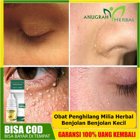 Obat Penghilang Milia Herbal Benjolan Benjolan Kecil Bintik Bintik Di Wajah Propolis Brazil Sm Shopee Indonesia