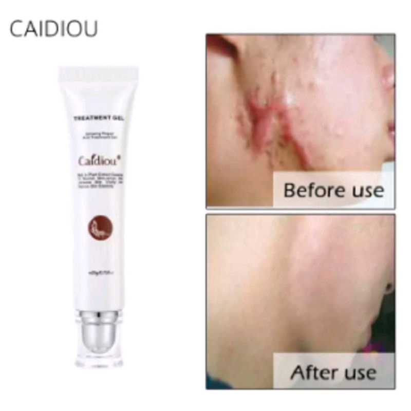 Cream Bekas Luka Obat Keloid Bekas Jerawat Treatment Bekas Operasi Perbaikan