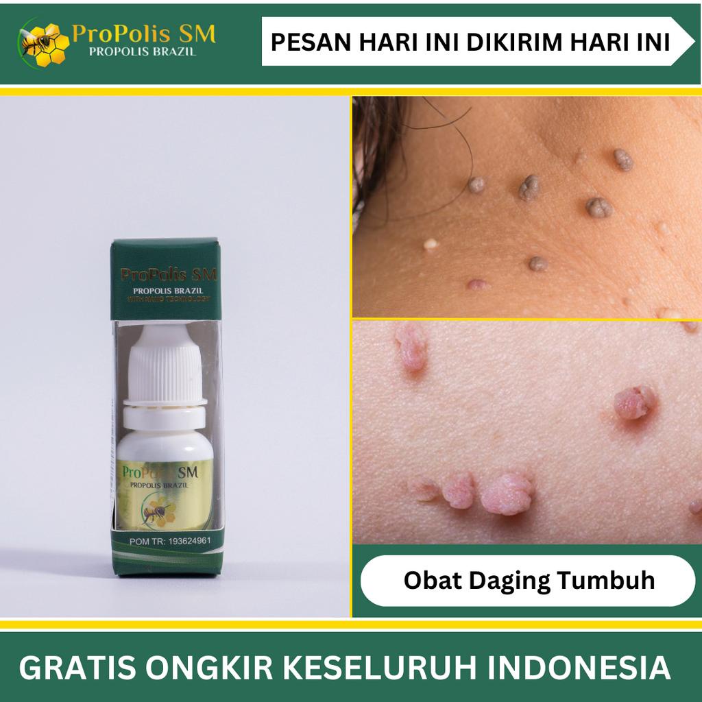 Propolis Sm Atasi Daging Tumbuh/Skin Tag, Kutil Di Kulit/Kelamin, Kelenjar Getah Baning, Papiloma, H