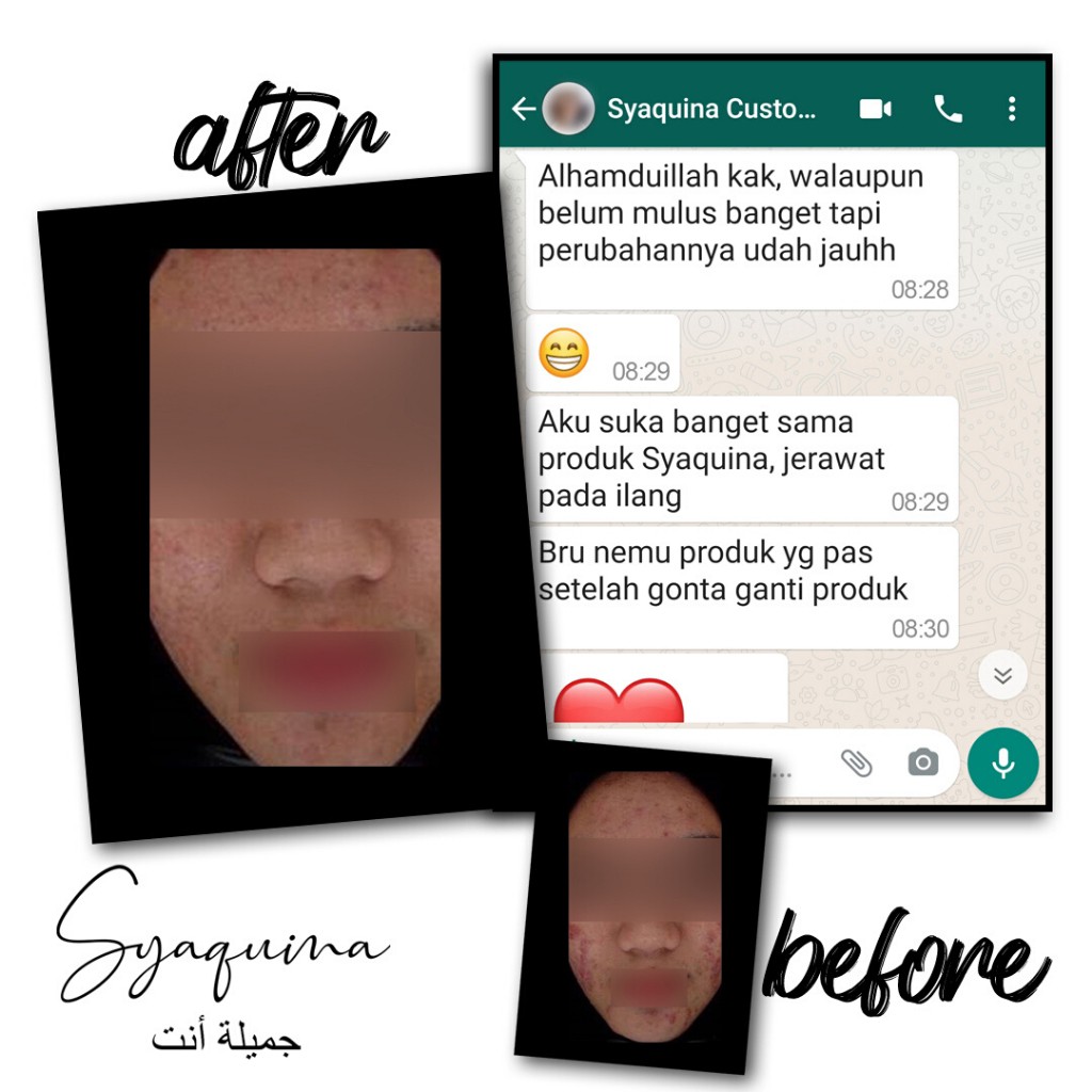Syaquina Premium Paket Acne Series / Skincare Kulit Jerawat & Berminyak / Formulasi Dokter BPOM MUI-2