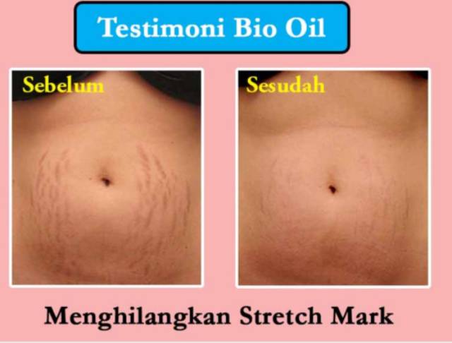 Testimoni bio oil Bio Oil: