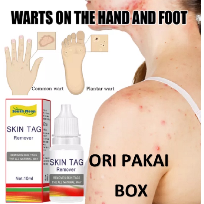 SKIN TAG Obat Penghilang Kutil Tahi Lalat Papiloma