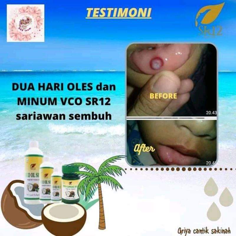 VCO Oil SR12 Obat Sariawan - Obat Sakit Gigi dan Bau Mulut