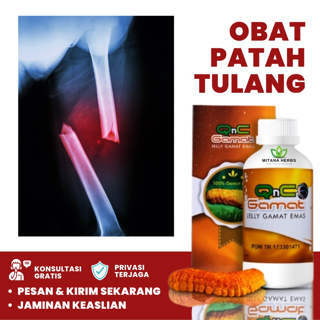 Mitana Herbal, Obat Patah Tulang Dan Retak, Obat Herbal Patah Tulang, Obat Patah Tulang Kaki, Obat P