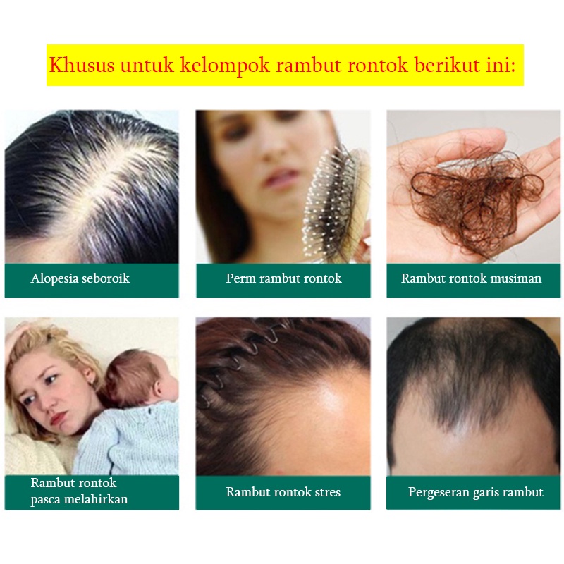 Serum rambut rontok Shampo anti rontok Serum rambut botak prevent hair loss hair growth essence oil 70ml dan spray 30ml penumbuh rambut Rambut kering, kusut, ujung bercabang, perm dicat Memperbaiki Tidak perlu dicuci