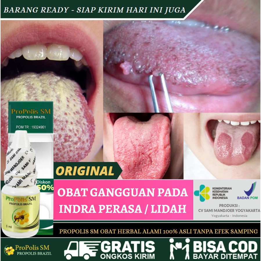 Obat Sariawan Menahun, Sariawan Lam, Sariawan Parah, Perih, Benjolan Daging, Propolis SM 100% Alami