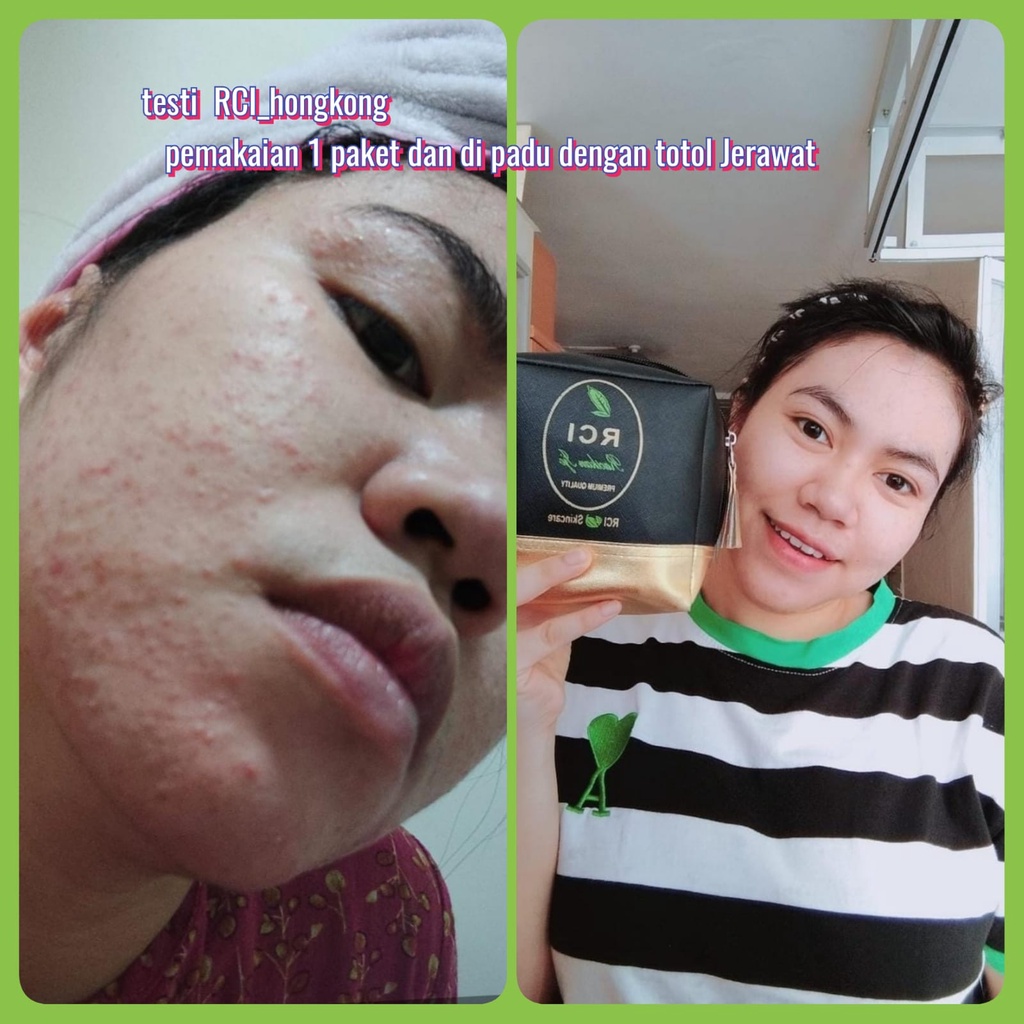 Paket Basic Acne | RCI SKINCARE-1