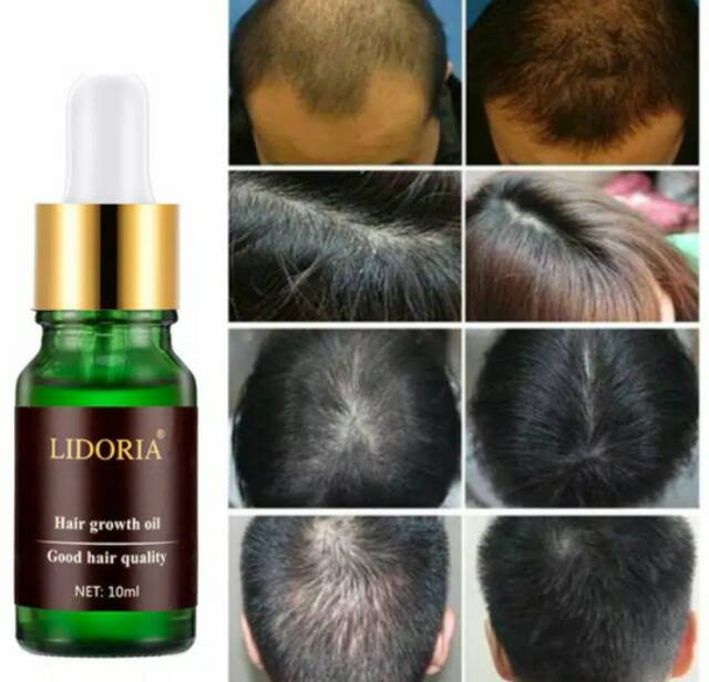 Herbal penyubur rambut atasi kebotakan