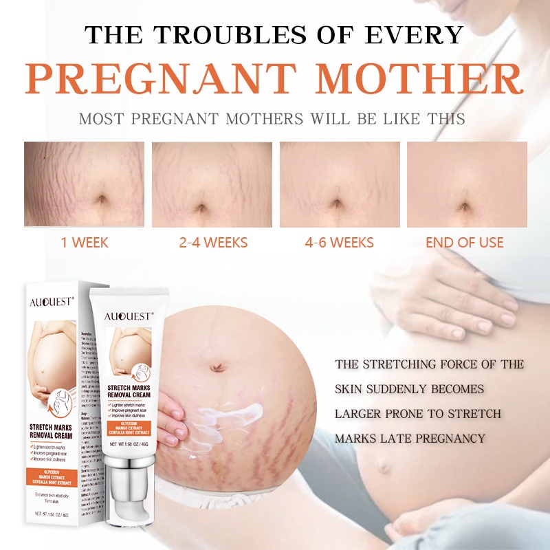 Penghilang strechmark  Strechmark cream Secara efektif menghilangkan stretch mark  Aman dan efektif