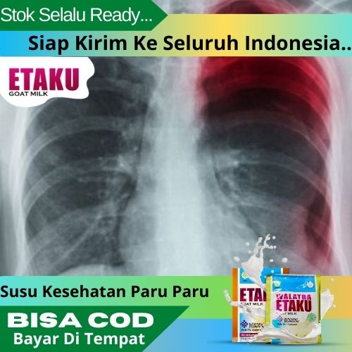 

Susu Kesehatan Paru paru, Obat Penyakit Paru paru Susu Kambing Etawa Walatra Etaku Bernutrisi
