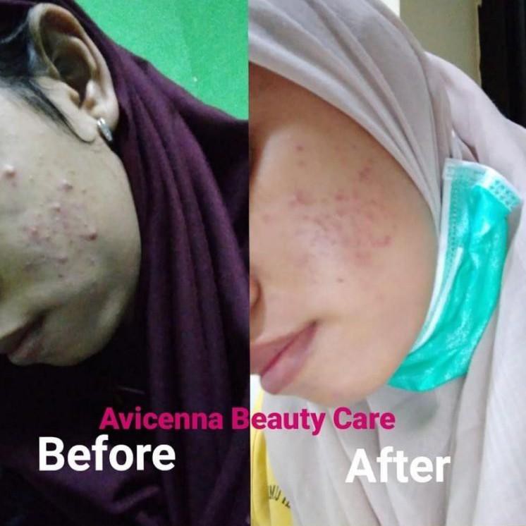 JeelΔs pr𝓞m𝓞 (COD) Paket Acne + Brightening Avicenna BPOM..T3rhot