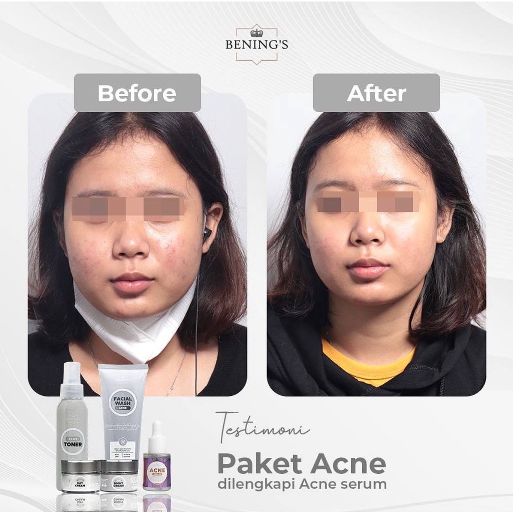 Bening Skincare Dr Oky Pratama Paket Acne Terbaik (Free Gift) Benings Skincare - Benings Clinic Paket Jerawat-8