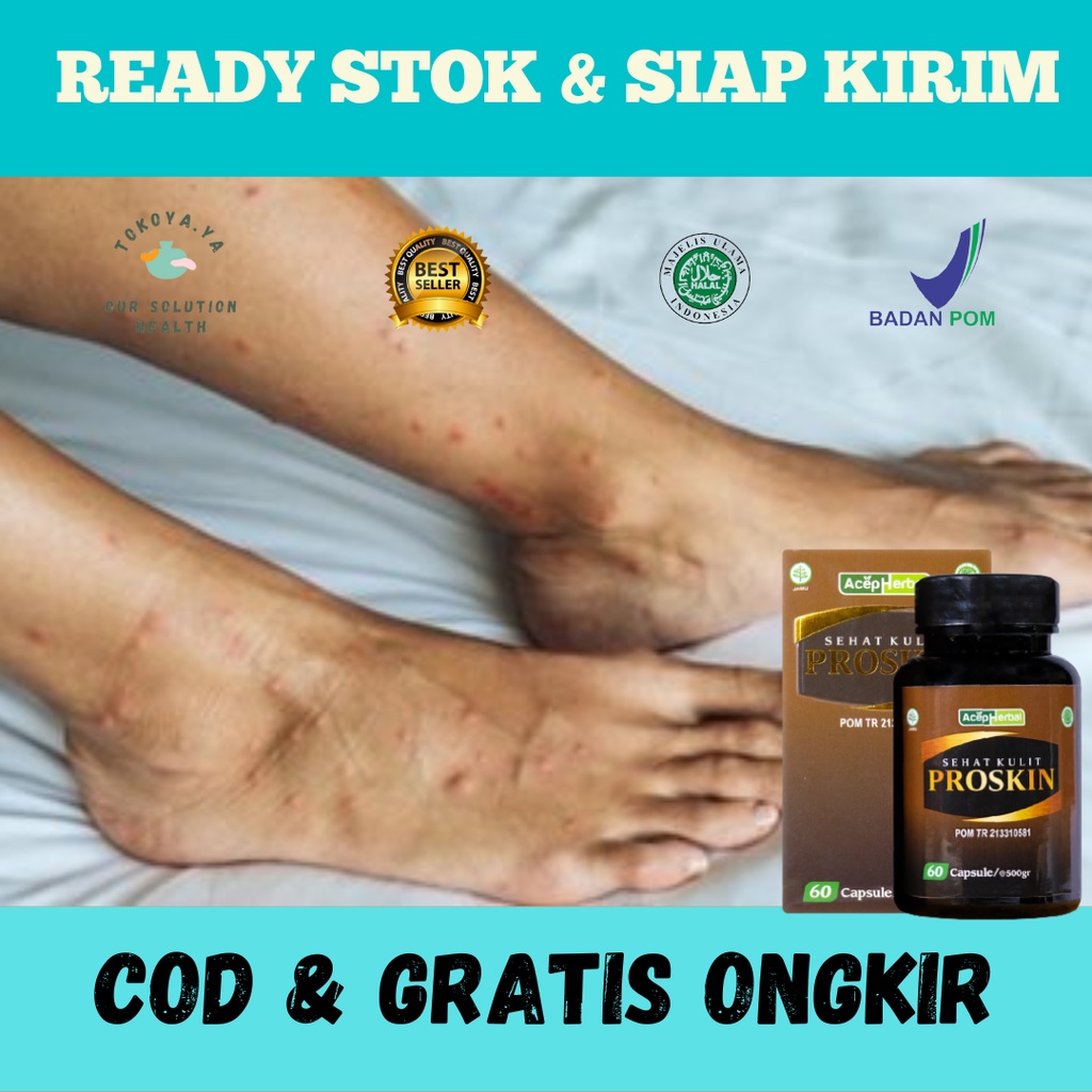 PROSKIN, Obat Korengan di Kaki, Obat Menghilangkan Bekas Luka Lama Hitam Koreng, Obat Luka Bekas Kor