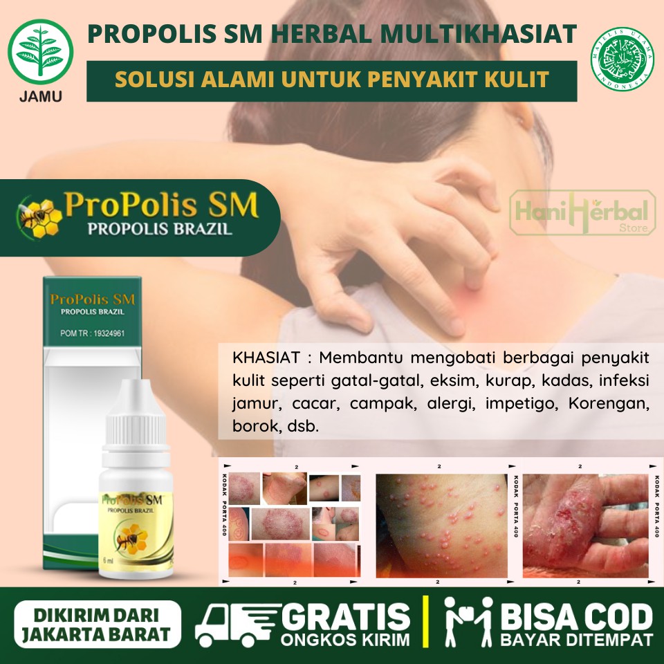 [COD] OBAT GATAL GATAL KORENG EKSIM PENGHILANG KORENG PENYAKIT KULIT OLES & MINUM - PROPOLIS SM ASLI