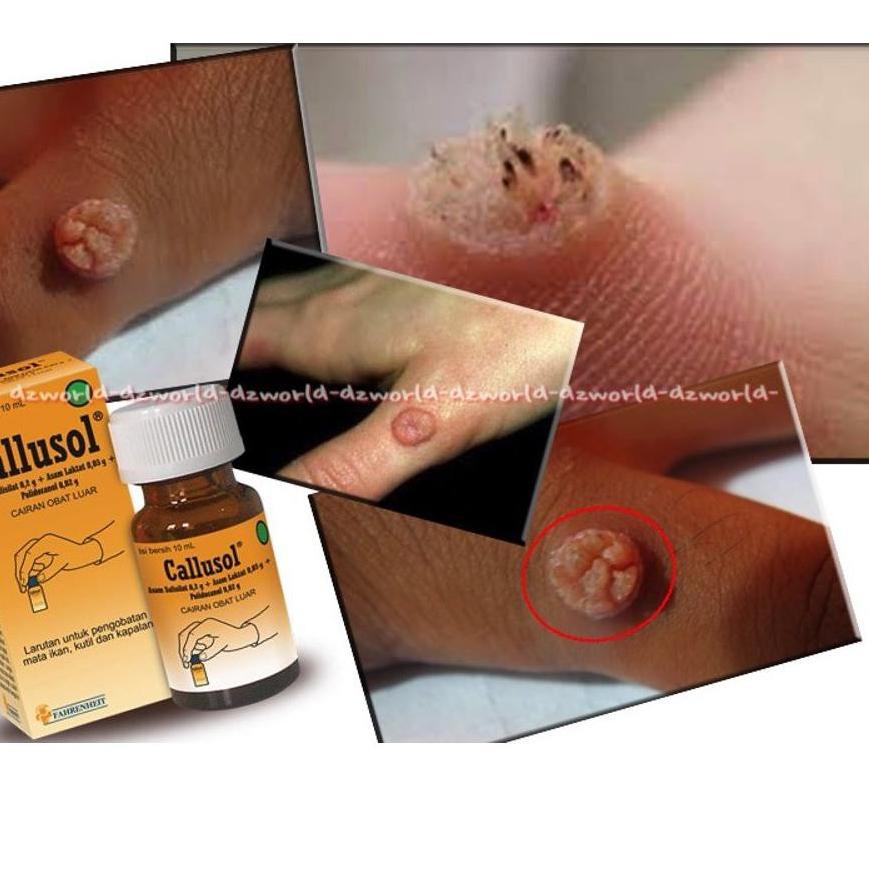 E-925 Obat Mata Ikan Kutil Callusol 10 ml ORI Kapalan Kutilos KUTILOS CALUSOL KALUSOL