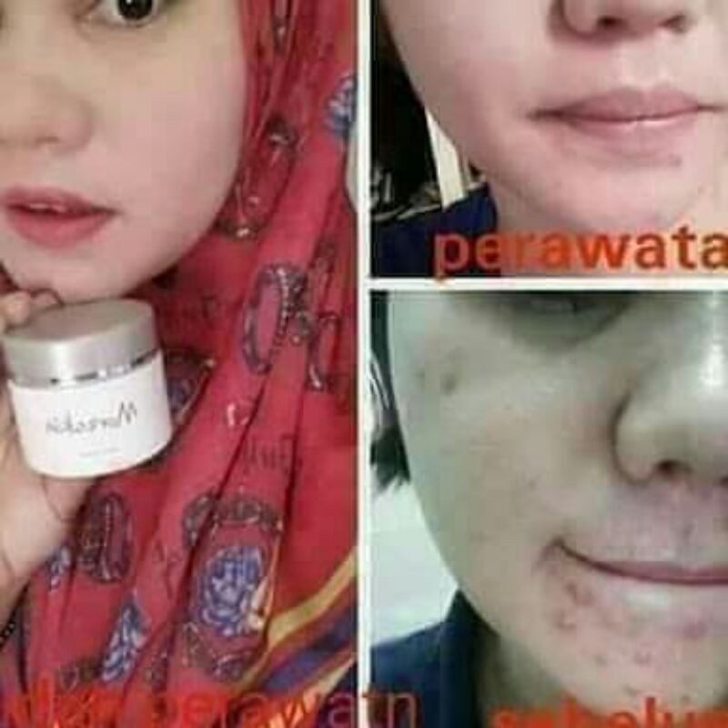 

TERLARISSS!!! X ACNE(MENGATASI WAJAH BERJERAWAT)