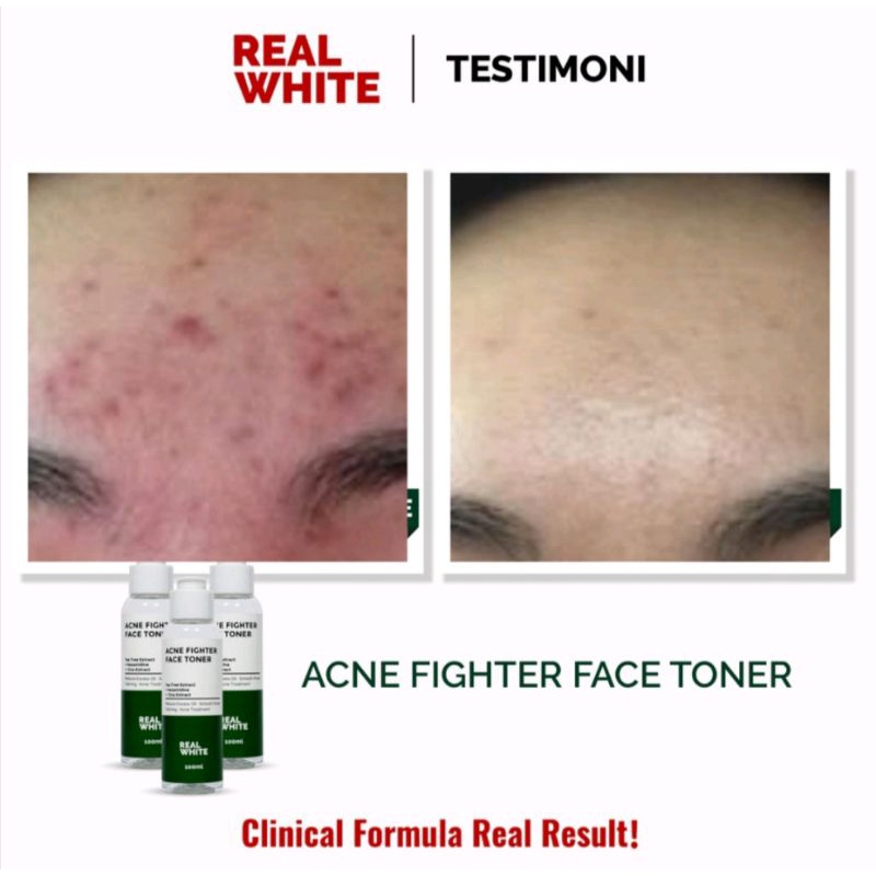 Real white acne fighter face toner/tea tree extract 100ml