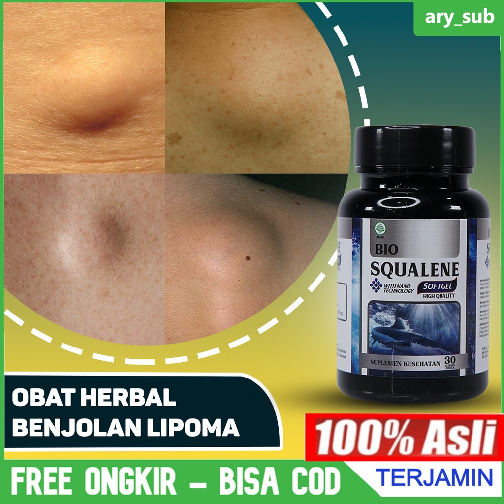 Jual Obat Penghilang Benjolan Lipoma - Benjolan Di Tangan - Kista ...