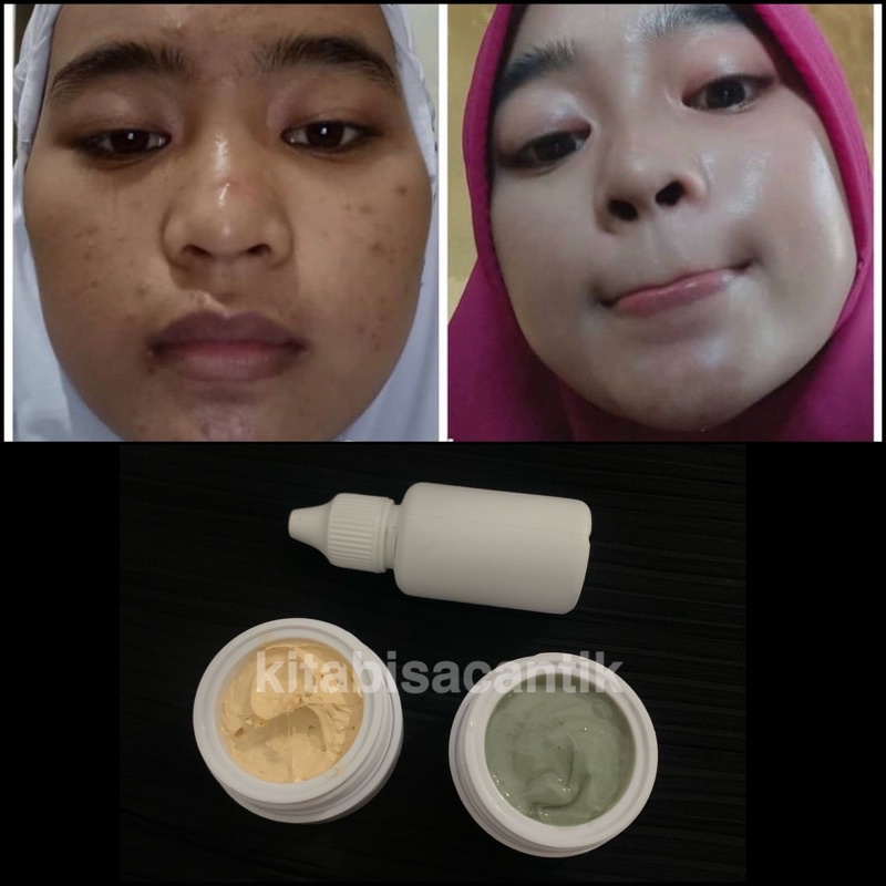 Paket Acne Cream Vitamin Glowing / Vit glow / cr glow