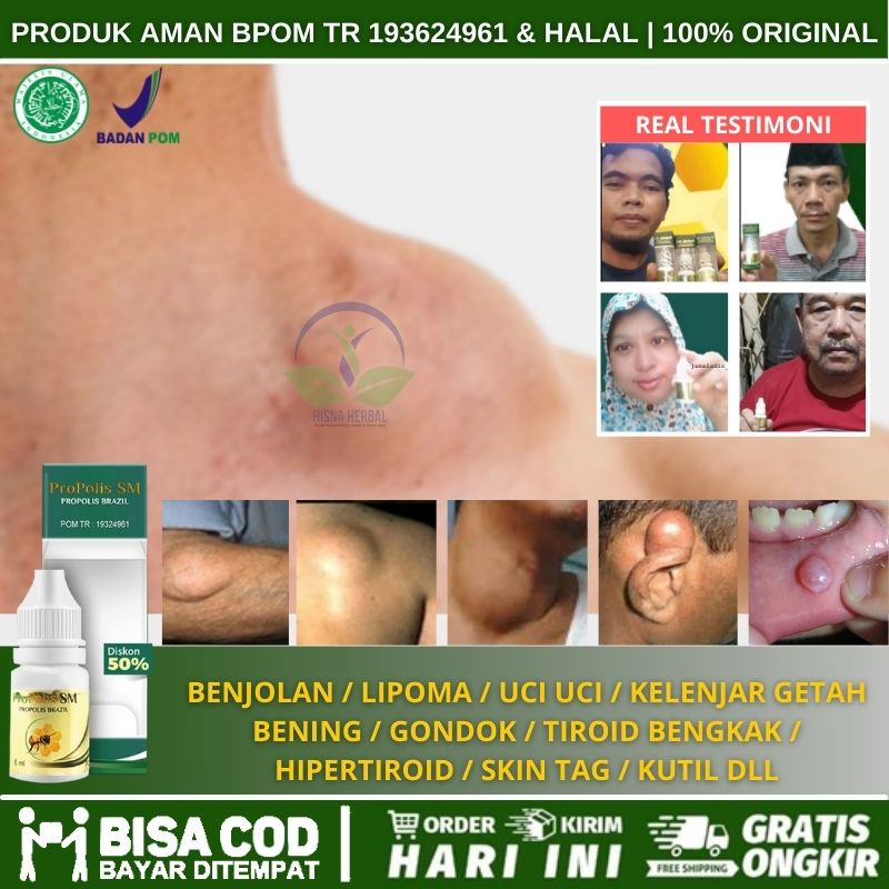 Obat Penumpas Benjolan Di Bibir Dubur, Menghilangkan Benjolan Di Luar Anus, Penghancur Benjolan Di D