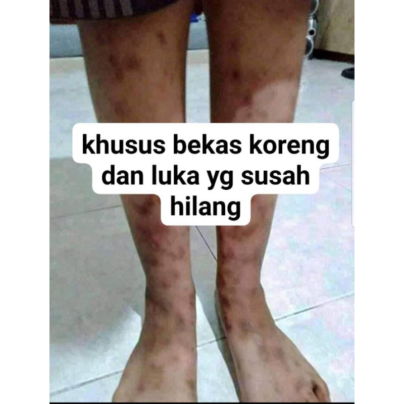 CREAM BEKAS KORENG DAN LUKA DOSIS TINGGI