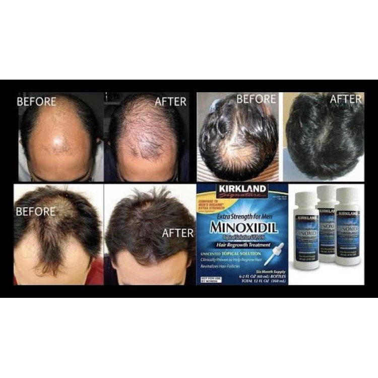 Kirkland - Minoxidil 5% ( 1 Kotak Isi 6 Botol)