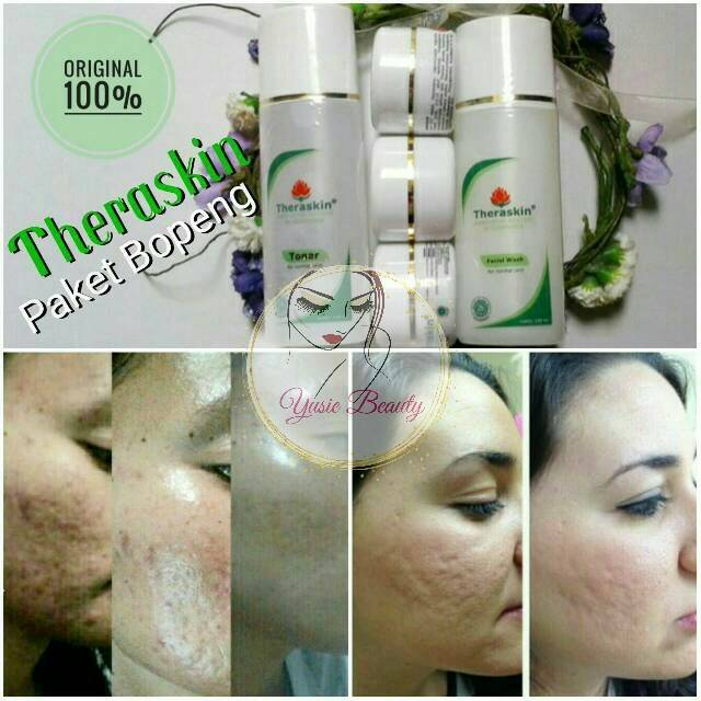 THERASKIN PAKET BOPENG WHITENING - SCAR - ORIGINAL - BPOM - Penghilang bekas Bopeng + Scar