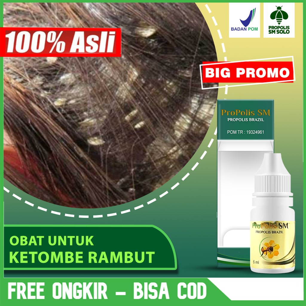 Obat Ketombe Rambut, Ketombe Kering, Ketombe Basah, Gatal Ketombe Di Kepala Propolis SM Asli Di SOLO