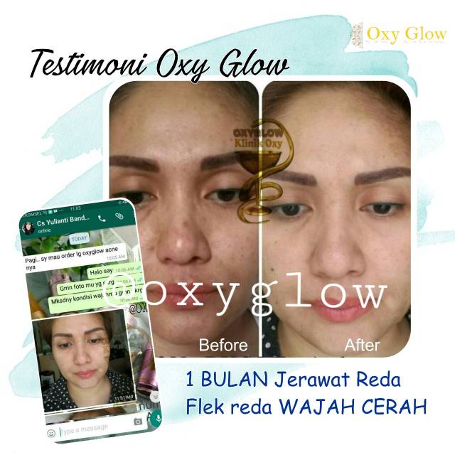 Paket Skincare Flek/Acne/Whitening OxyGlow Bonus Pouch Croco (Leather Bag)-5