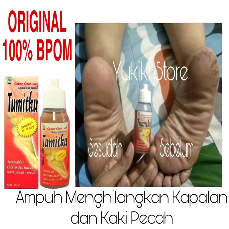 TUMIT OBAT KAKI PECAH2 OBAT KAKI PECAH2 DAN KERING AMPUH OBAT KAKI RAYAPAN KRONIS MURAH