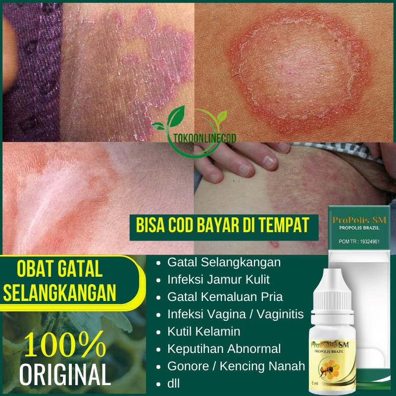Obat Gatel Selakangan - Gatal Kelamin Pria - Jamur Kulit Selangkangan - Kulit Kering Bersisik PSM