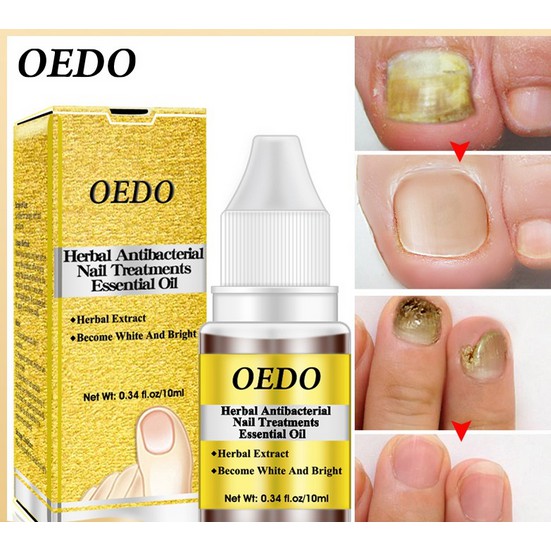ORIGINAL OEDO Minyak Herbal Herbal Anti Bakteri untuk Perawatan Kuku Perawatan Tangan & Kaki