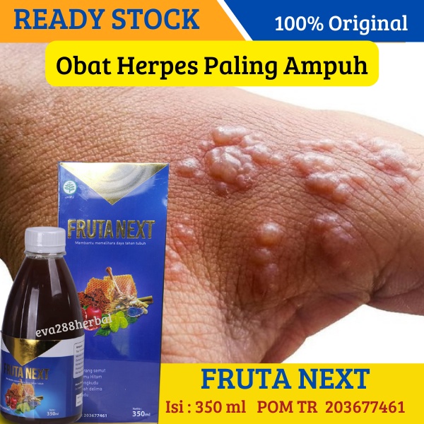 Frutanext Obat Herpes Eksim Kering Eksim Basah Borok Dan Budug Alergi Kulit