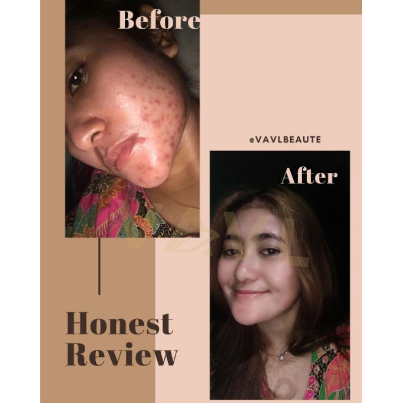 Paket Acne Package Vavl Beaute by Vivalentine free Pouch-3