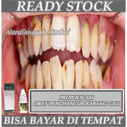Obat Penghancur Karang Gigi, Karang Gigi Gusi, Pembersih Karang Gigi