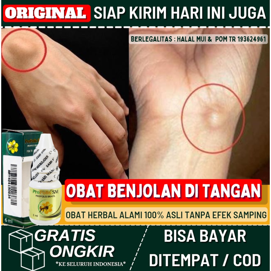 Obat Benjolan di Tangan, Obat Pengecil Benjolan Tumor Jinak di Tangan, Penghilang Benjolan Lipoma, G