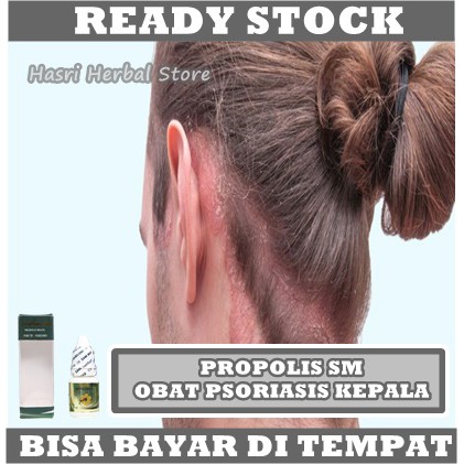 Obat Psoriasis Kulit Kepala - Obat Kulit Kepala Kering, Gatal, Bersisik, Berkerak, Jamur Di Kepala, Borok Di Kelapa, Jamur Kulit, Ketombe Parah, Ketombe Berkerak Dengan ProPolis SM Brazil 100% Original