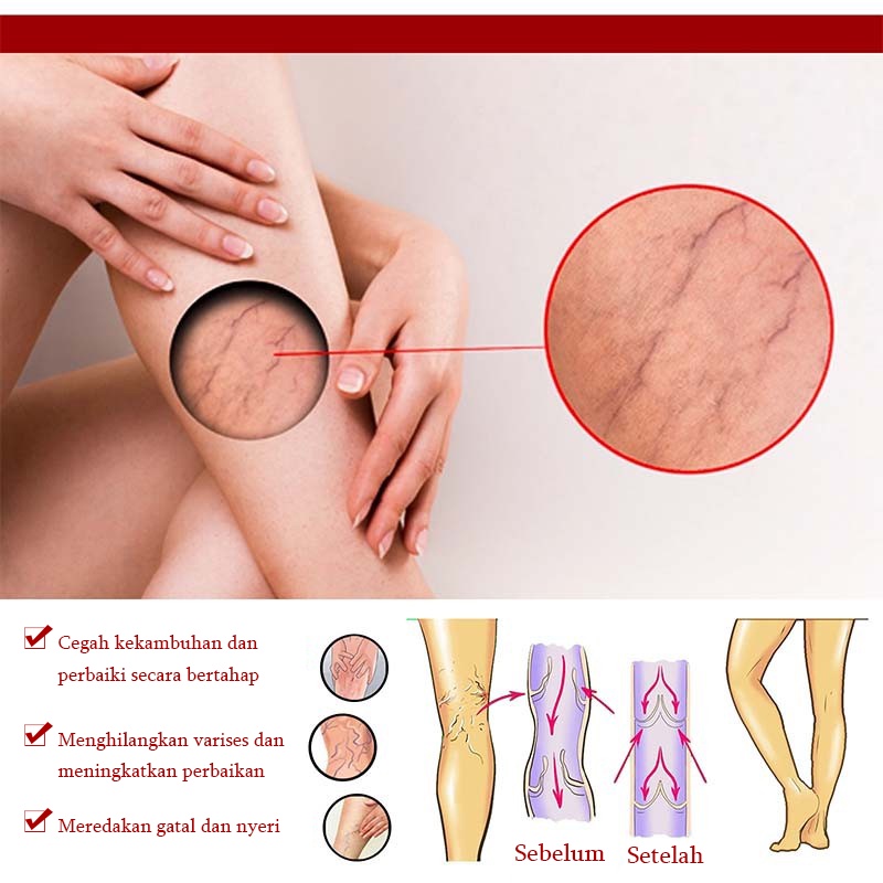 Terlaris !!! Varicose Veins Obat Varises Varikokel Bengkak Benjolan Buah Zakar Nyeri Testis Paling Ampuh Varicose Veins Treatment Cream/Obat Krim Varises Parises Tanpa Operasi