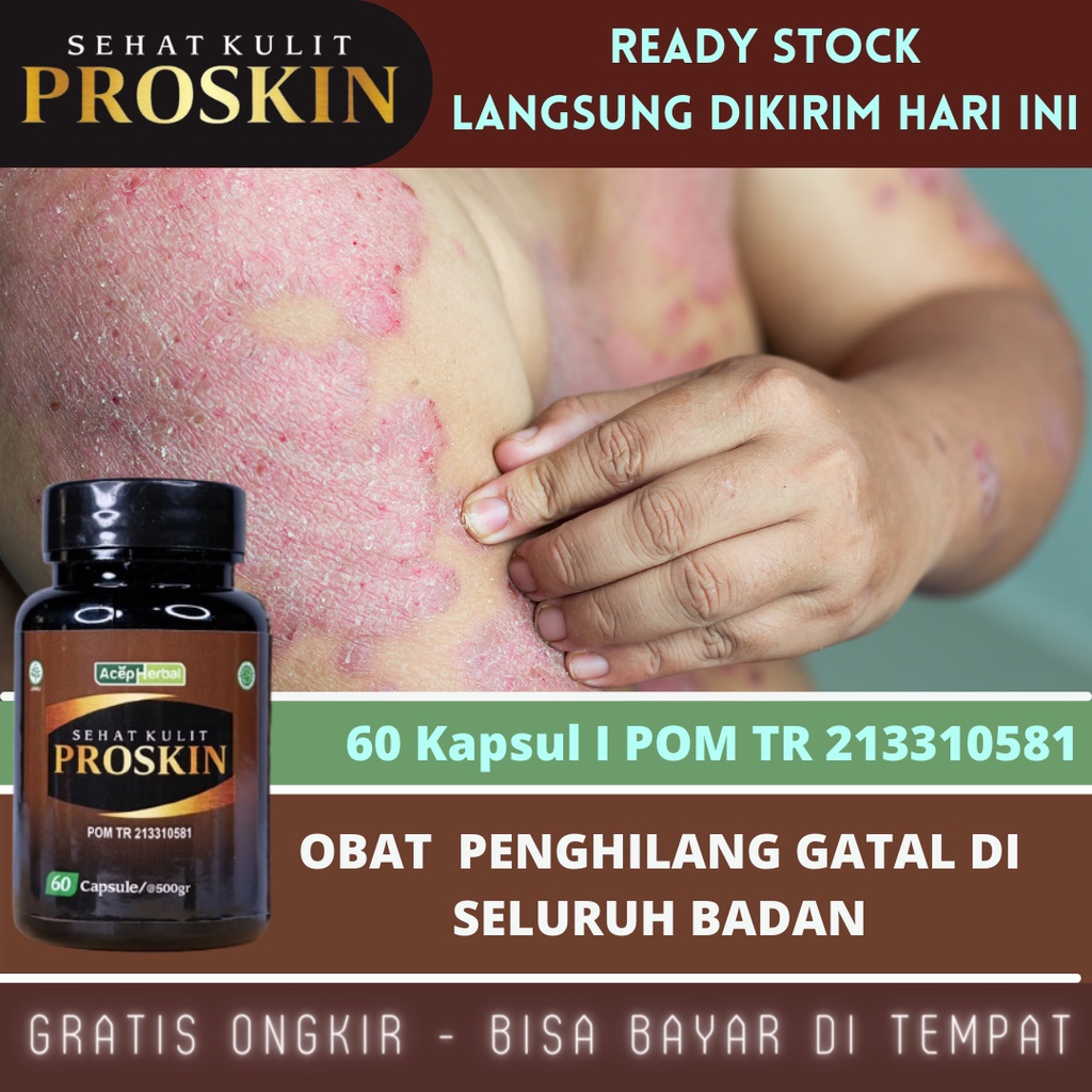 Obat Badan Gatal-Gatal, Obat Gatal Gatal Seluruh Badan, Obat Gatal Alergi, Obat Gatal Menahun, Obat Kulit Bersisik, Obat Gatal Kulit, Obat Gatal Merah-Merah, Obat Psoriasis, Obat Eksim Kering, Obat Gatal Berair, Obat Koreng Gatal Dengan Proskin