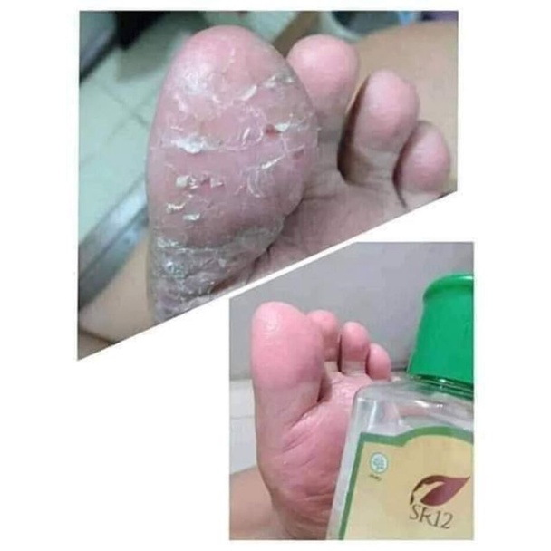 Obat Kaki Pecah dan Kering - Penghalus Tumit Kaki - Minyak Kaki Pecah2 Ampuh