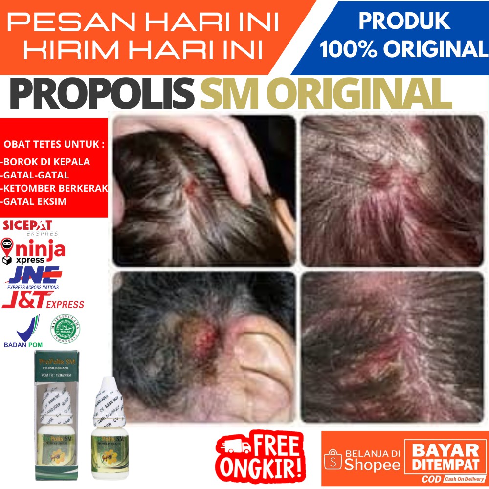 Obat Borok Kepala / Obat Borok di kepala / Obat Gatal-Gatal kepala / Pengilang Ketombe Berkerak / be