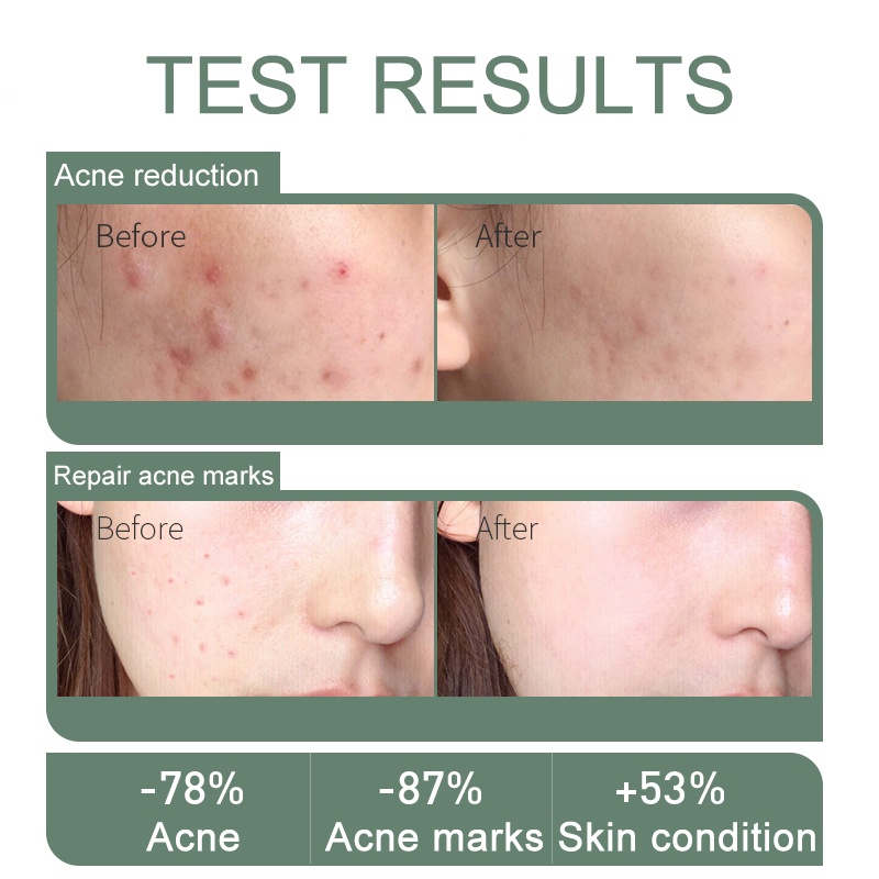 GIRLPAL Anti Acne Facial Cleanser 100g Tea Tree Acne Treatment Foam Pembersih Wajah Jerawat Wash
