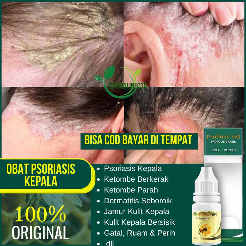 Obat Psoriasis, Kulit Kepala Bersisik, Dermatitis Seboroik, Cradle Cap, Cocok Untuk Bayi Anak Dewasa