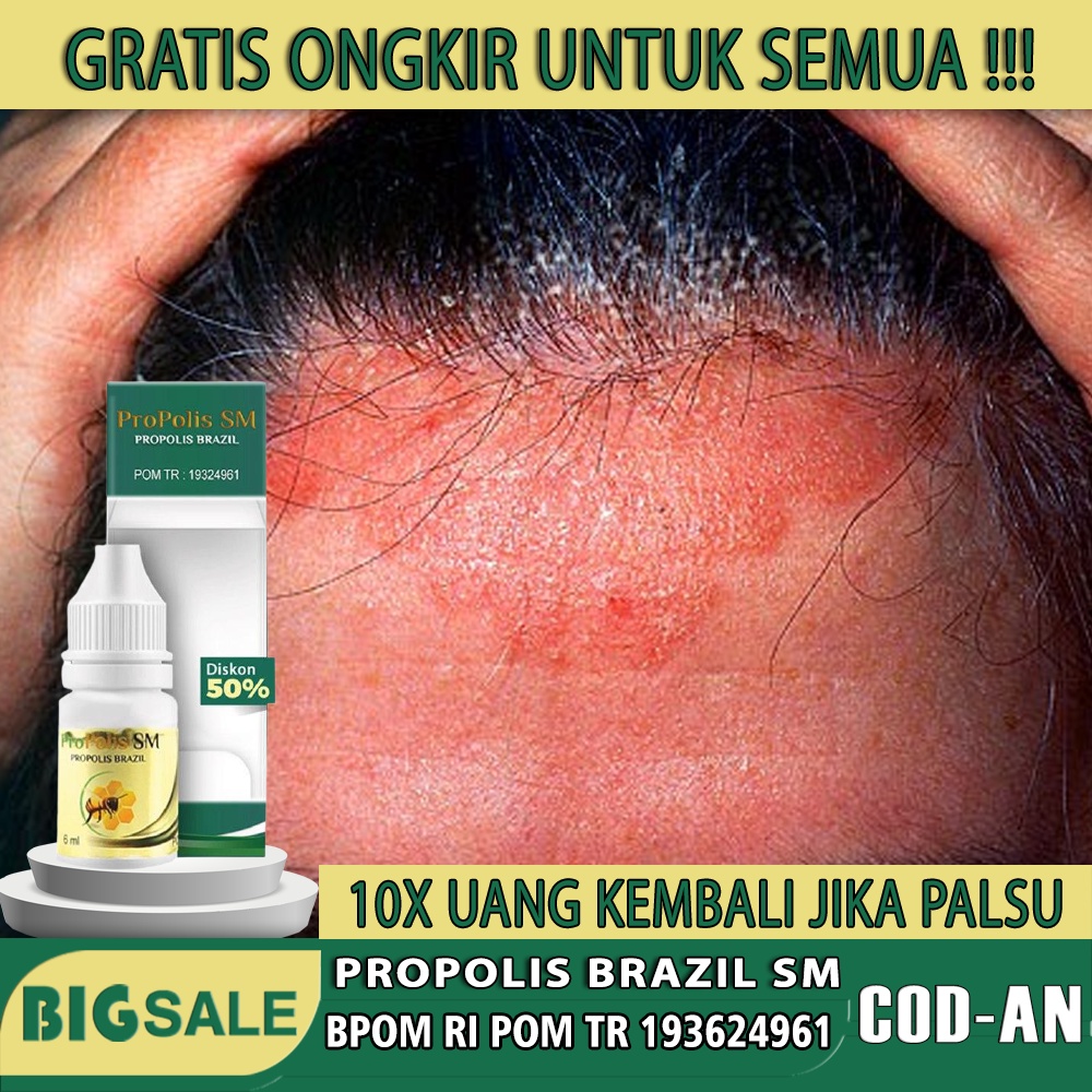 Propolis SM - Obat Jamur Kepala dan Kulit Kepala Kemerahan Gatal, Bersisik, Infeksi Jamur Kulit