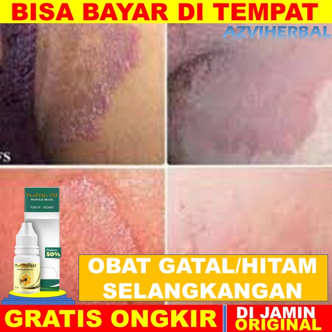 Obat selangkangan, obat gatel selangkangan, krim selangkangan hitam, obat kurap selangkangan, obat s